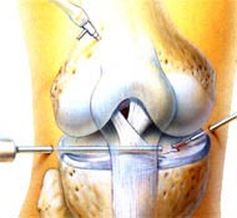 knee surgery medical illustration by Walter Stuart.