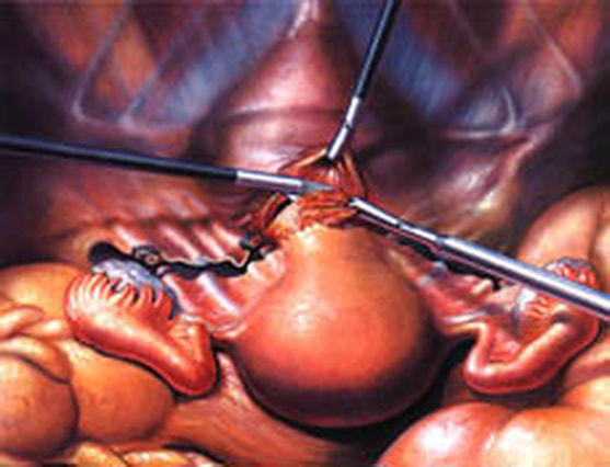 Uterine surgery medical illustration by Walter Stuart.